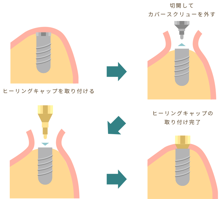 千種区覚王山デンタルオフィス増田のインプラント治療の流れ