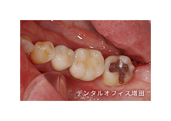 zimmer 気安い dental サージカルインプラントドリル 歯科器具